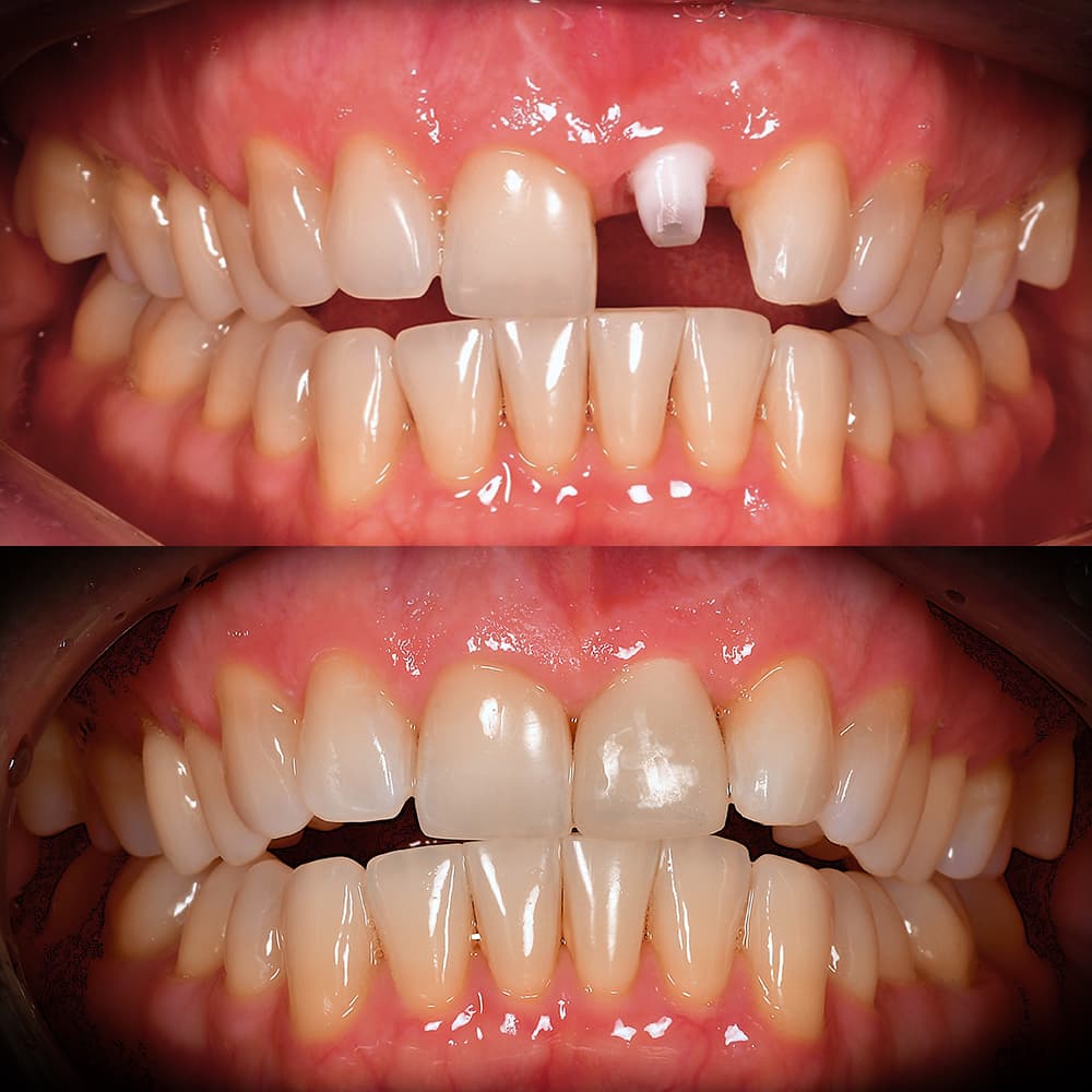 Before and after front tooth ceramic implant