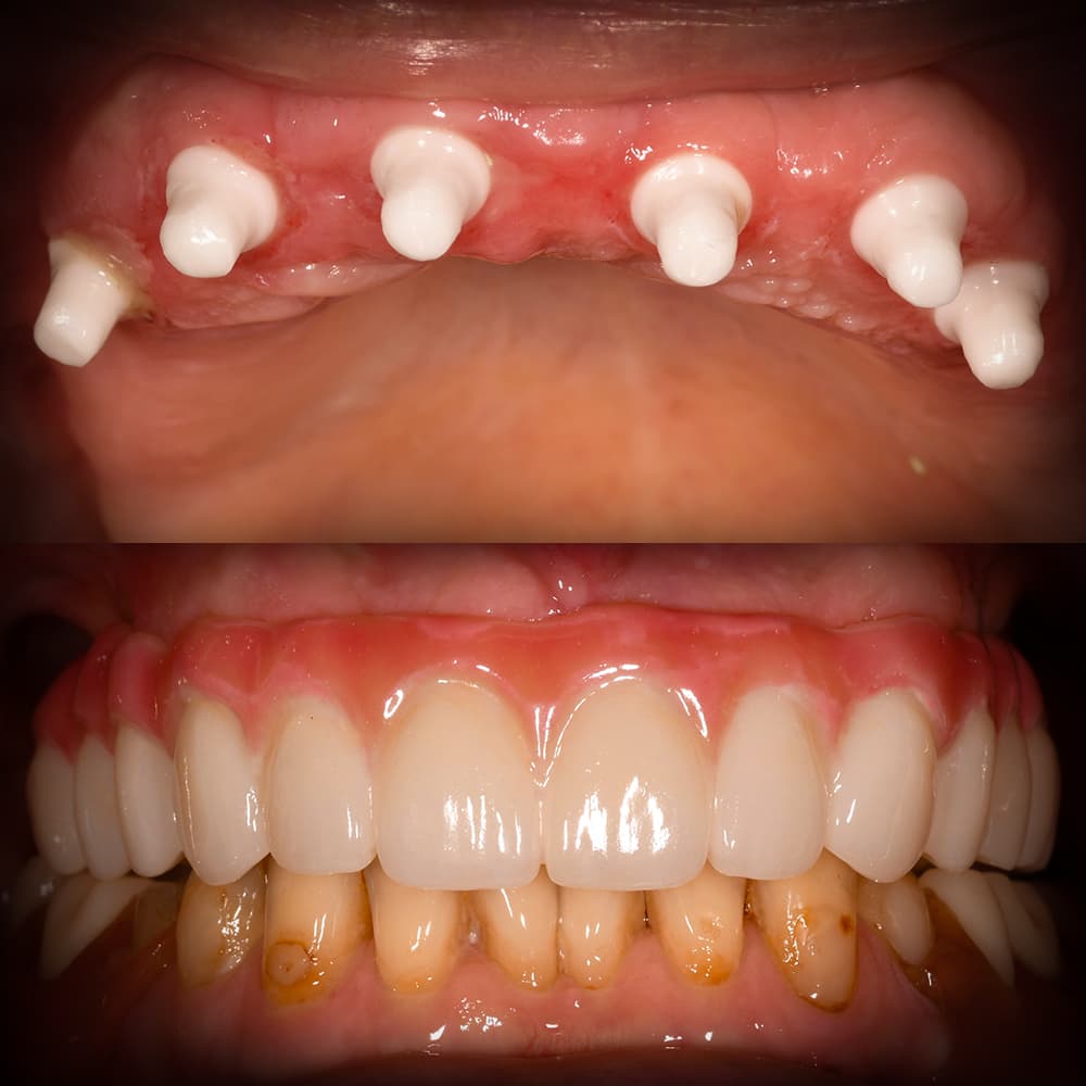 Before and after full mouth ceramic implants