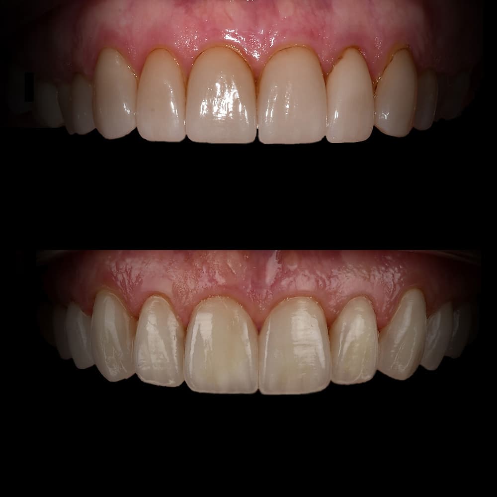 Before and after dental case 15