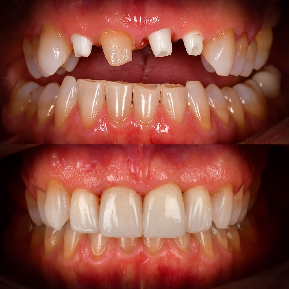 Before and after front tooth ceramic implant