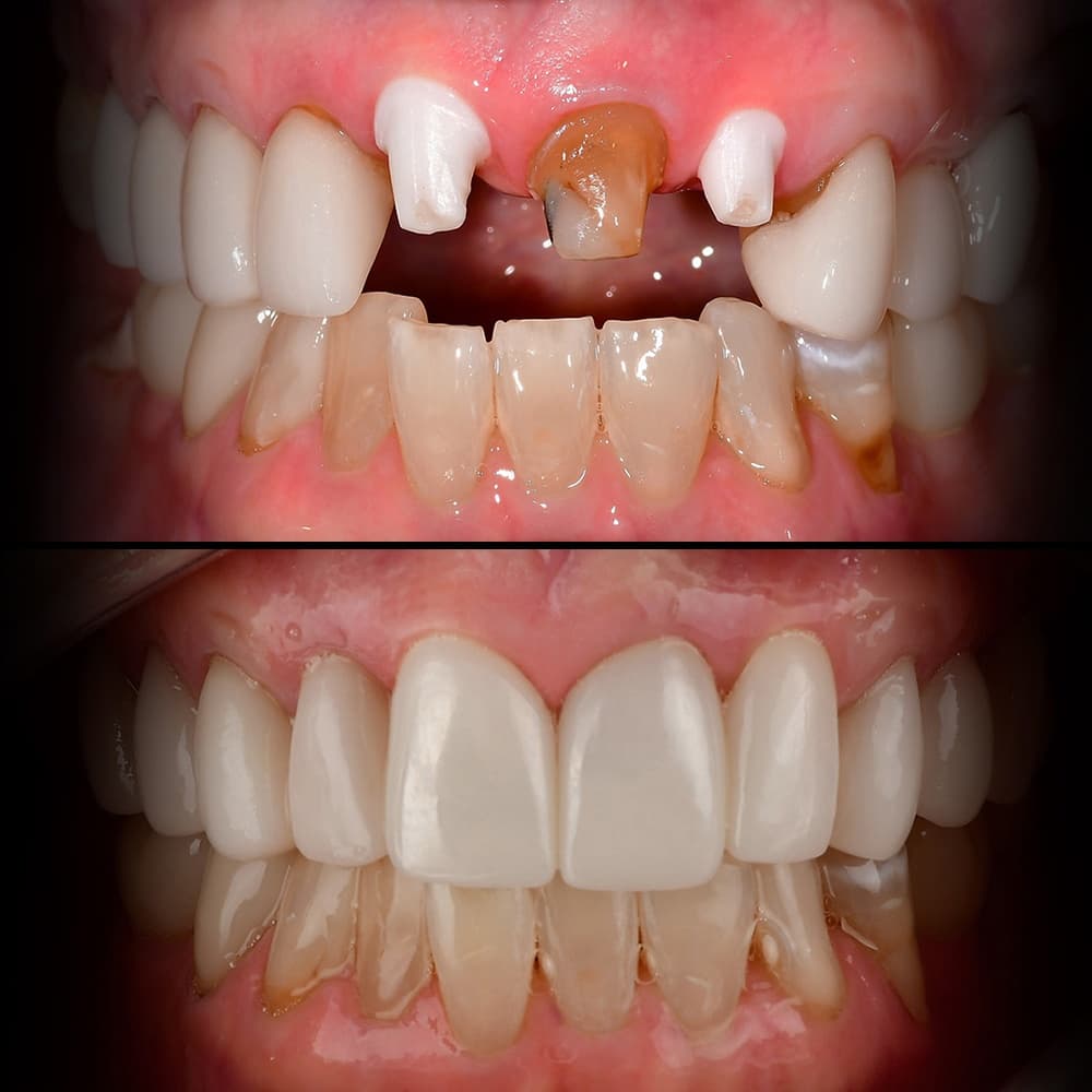 Before and after dental case 8