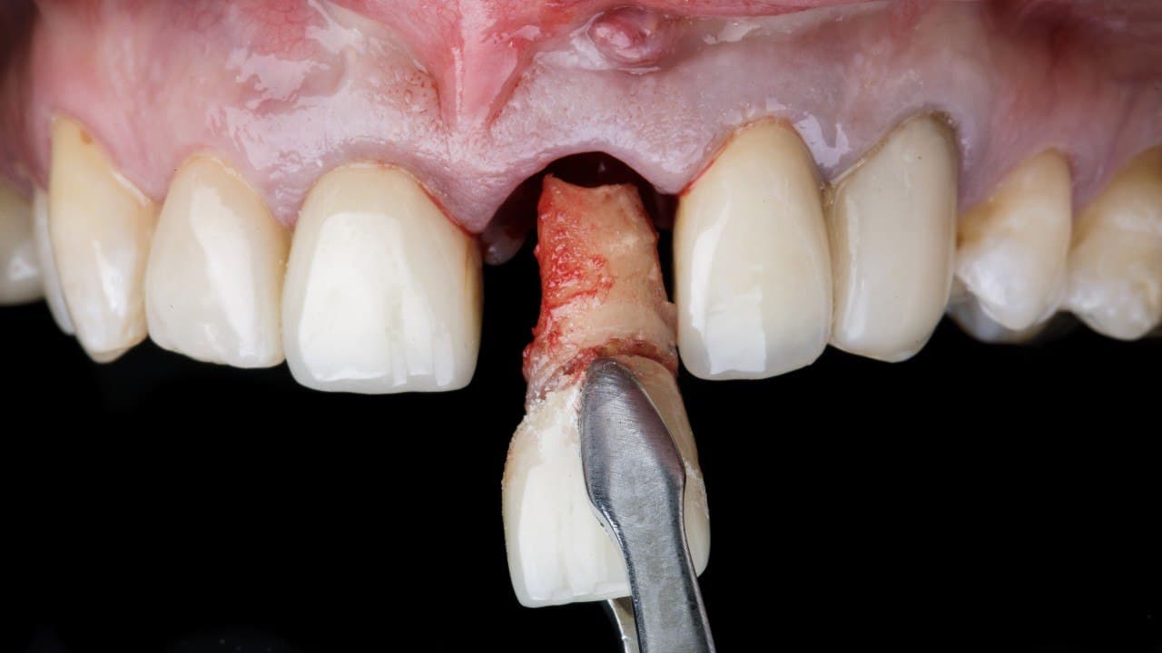 Biological extraction of a failing front tooth with full periodontal ligament removal