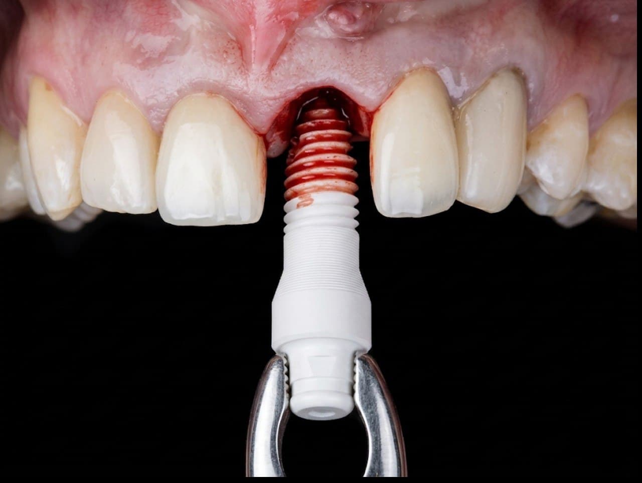 One-piece metal-free zirconia ceramic implant being placed into the prepared site