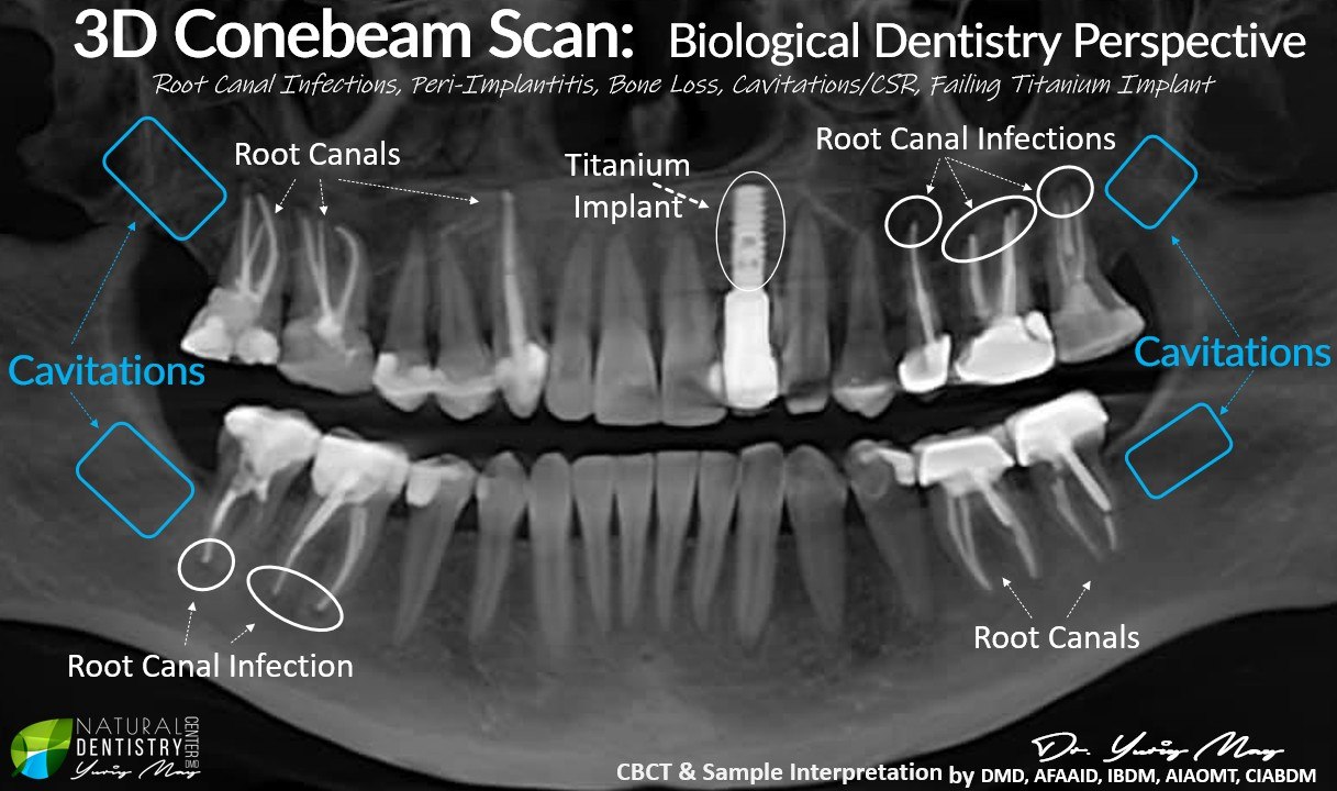 3D CBCT cone beam scan — biological dentistry perspective