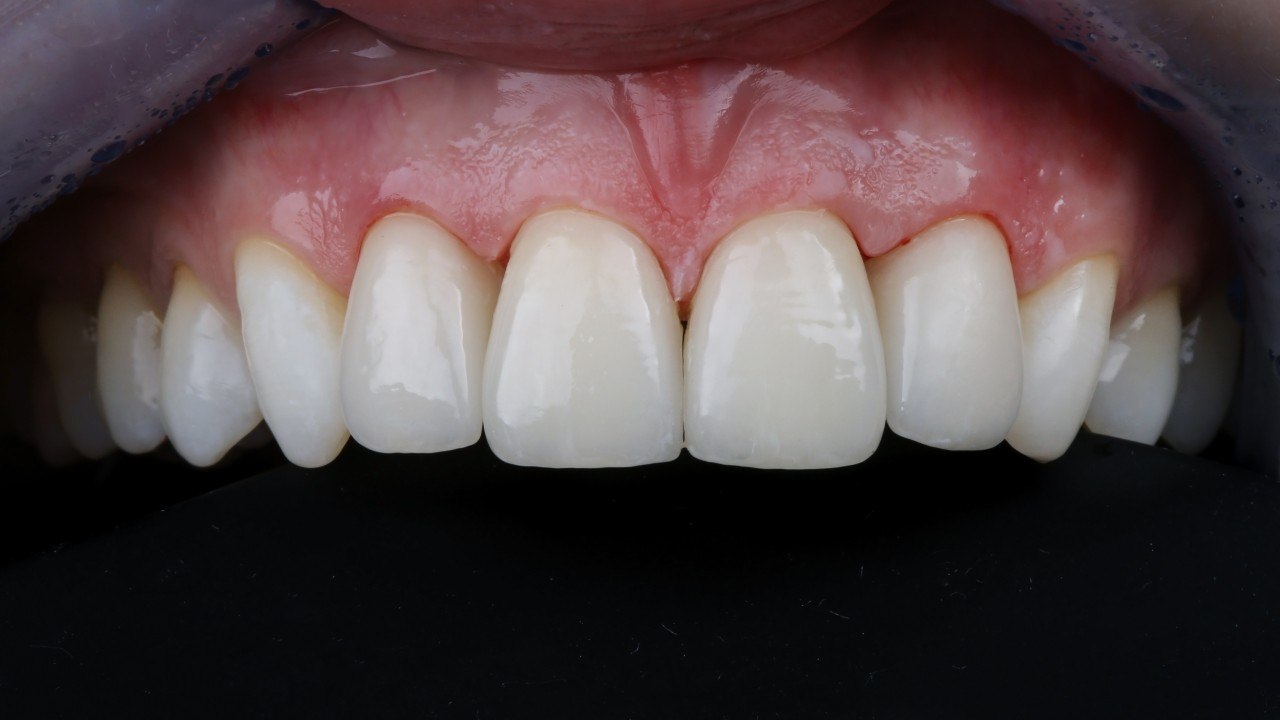 Final biocompatible ceramic crown — completed restoration